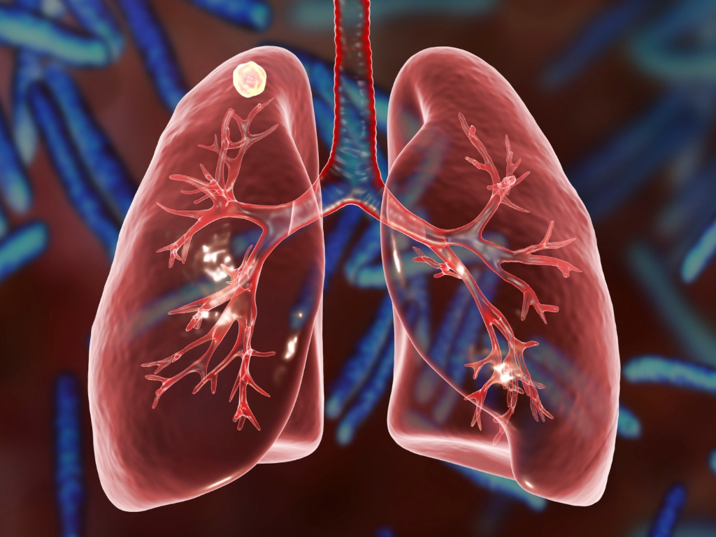 Chronic Bronchial Infection Is Associated with More Rapid Lung Function Decline