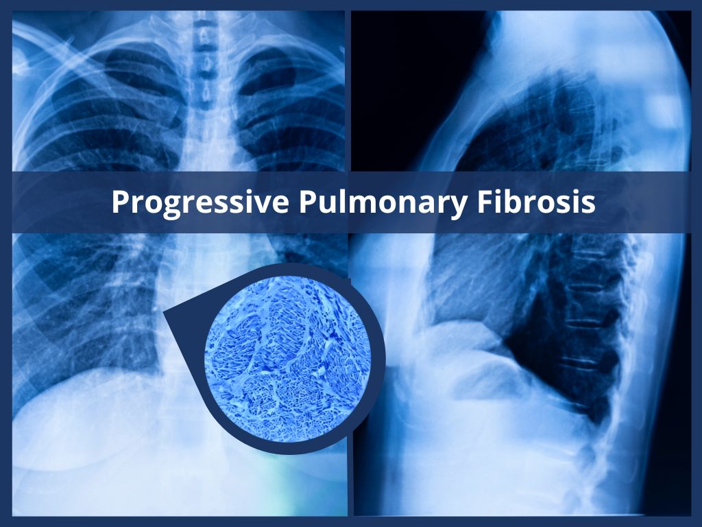 Progessive Pulmonary Fibrosis